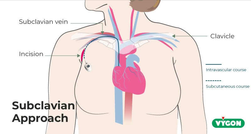 Subclavian approach for chest port placement