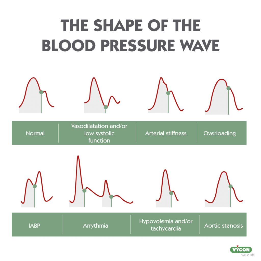 Infographic about the different shapes of the blood pressure wave