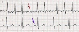 Several-P-waves-in-patients-with-atrial-fibrillation