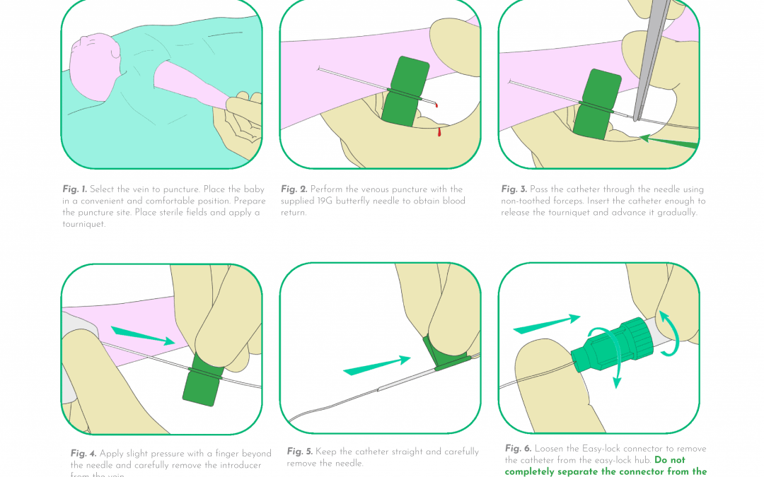 Catheter introduction with a butterfly needle