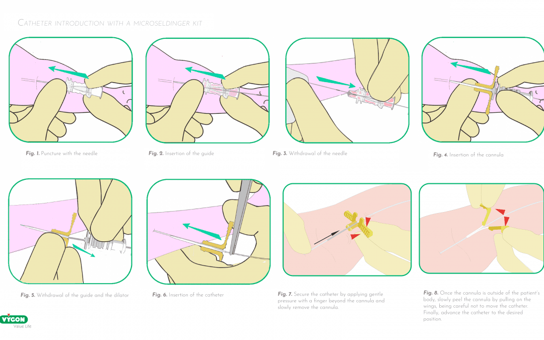 Catheter introduction with a microseldinger kit