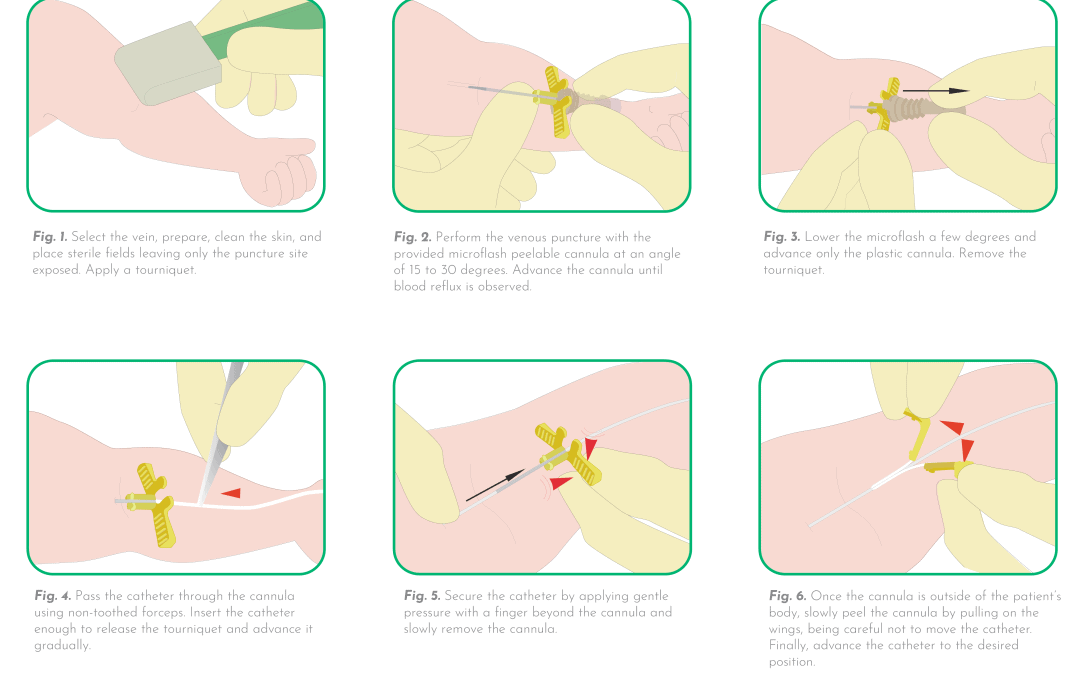 Catheter introduction with a peelable cannula