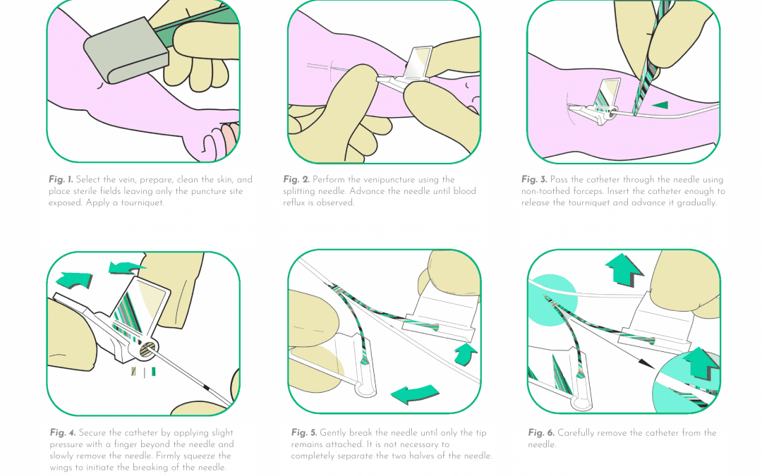 Catheter introduction with a splitting needle